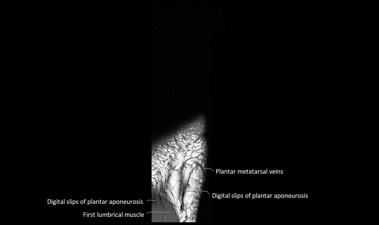 Great Toe micro anatomy MRI axial cross sectional 3T image 28.webp